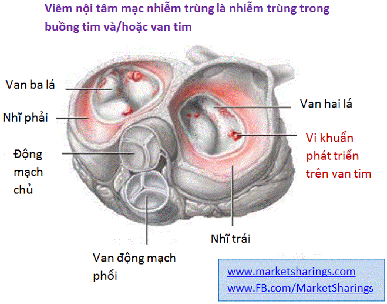 Ảnh 1 của Infective endocarditis